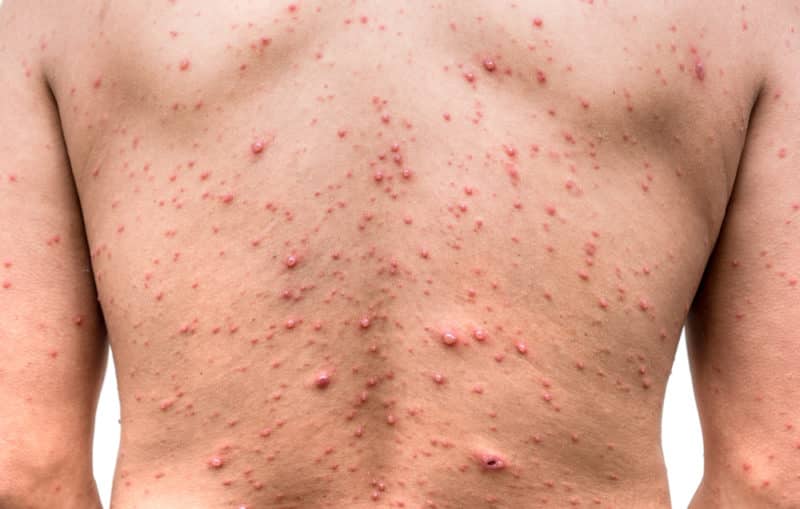 Early HIV Rash Hot Tub Folliculitis Prevention and Treatment Early HIV Rash Hot Tub Folliculitis Prevention and Treatment