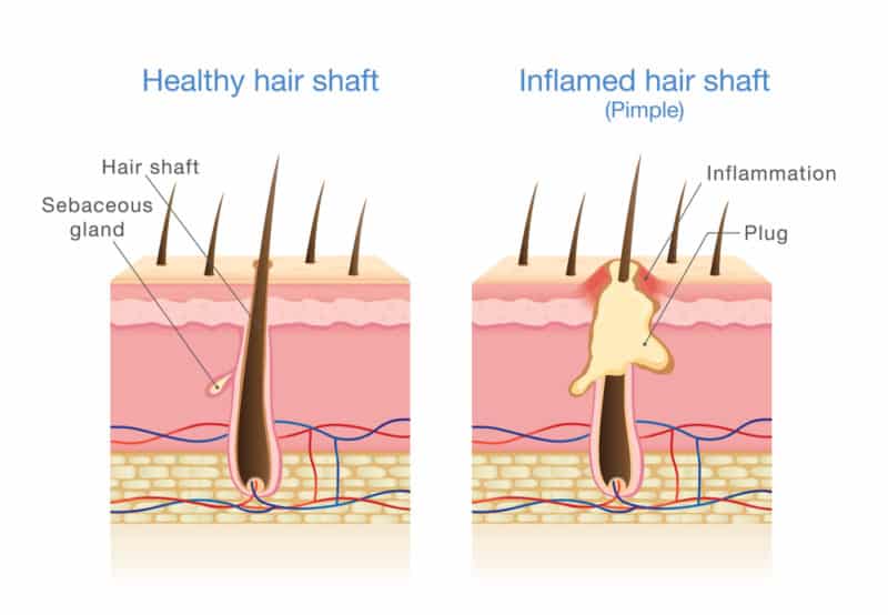 Hot Tub Folliculitis Prevention And Treatment